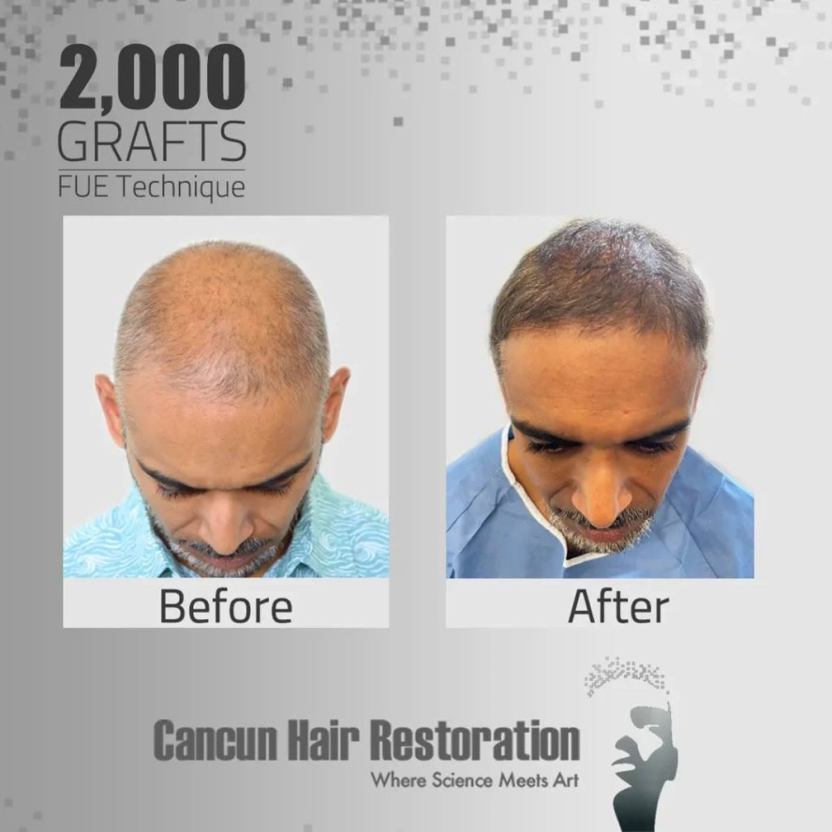 نتائج زراعة الشعر بتقنية FUE مع 2000 طعم في Cancun Hair Restoration قبل وبعد