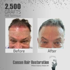 FUE hair transplant before and after results at Cancun Hair Restoration, 2,500 grafts procedure