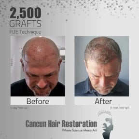 Before and after FUE hair transplant at Cancun Hair Restoration, 2,500 grafts result