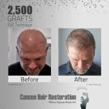 Before and after FUE hair transplant at Cancun Hair Restoration, 2,500 grafts result