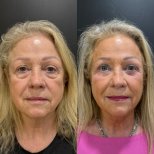 Vorher-nachher-Ergebnis der Unterlid-Blepharoplastik bei Dr. Alexandro Aguilera - Plastische Chirurgie