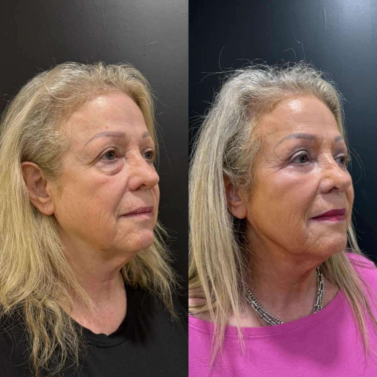 نتائج شد الجفن السفلي قبل وبعد في Dr. Alexandro Aguilera - Plastic Surgery
