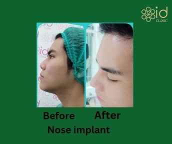 Before and after nose implant results at ID Clinic Bangkok, improved nose shape and profile
