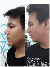 Before and after rhinoplasty results at ID Clinic Bangkok, improved nose shape and profile