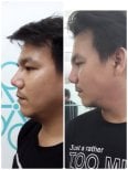Before and after rhinoplasty results at ID Clinic Bangkok, improved nose shape and profile
