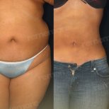 Before and after 360 liposuction results at Memorial Şişli Hospital, visible body contouring