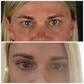 Before and after blepharoplasty results at Soraca Med, eyelid correction for refreshed look