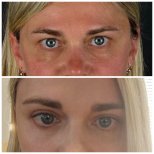 Before and after blepharoplasty results at Soraca Med, eyelid correction for refreshed look