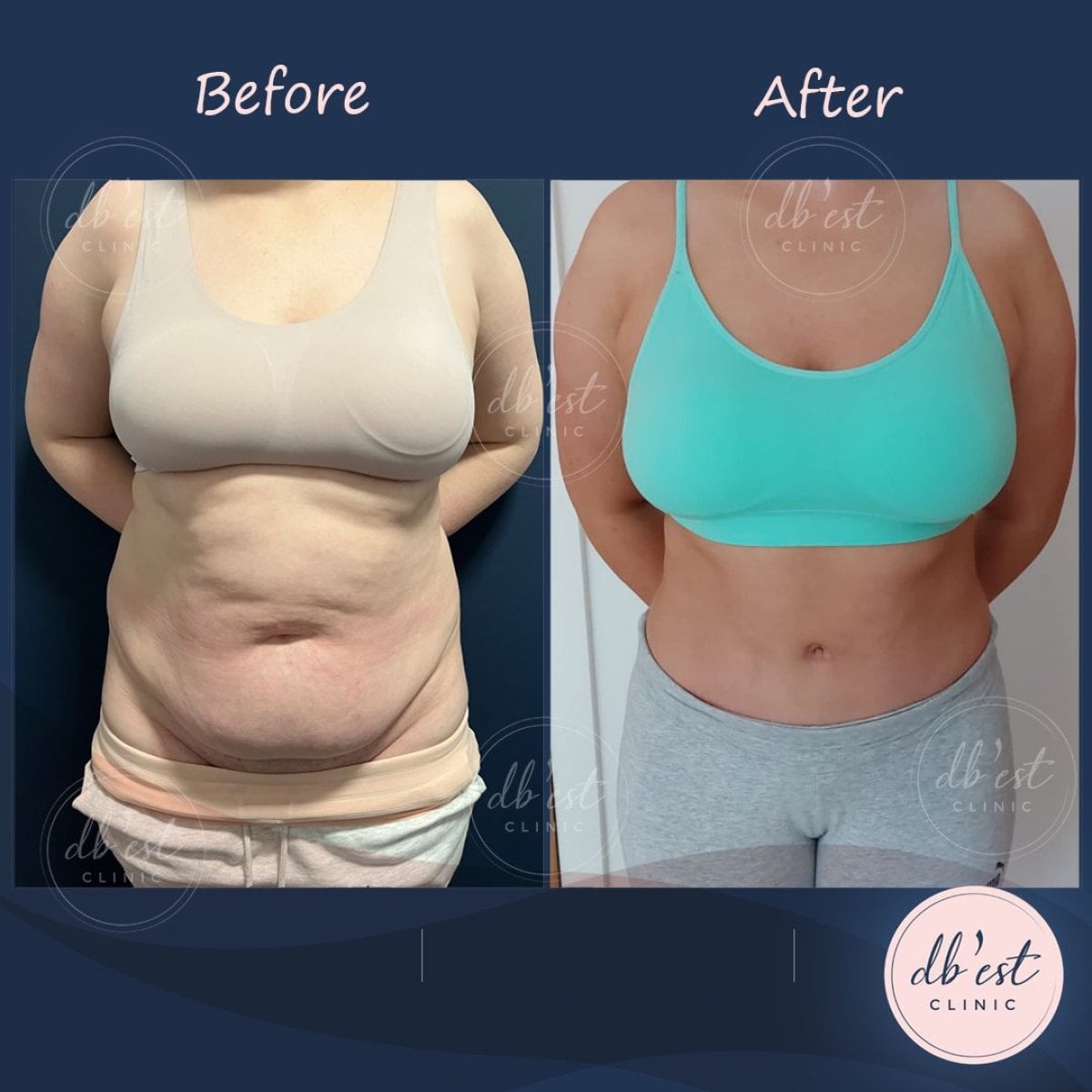 Resultados de abdominoplastia antes y después en Db'est Clinic – mejora del contorno abdominal
