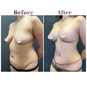 Before and after tummy tuck results at Db'est Clinic – improved abdominal contour