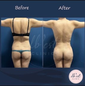 Before and after Vaser liposuction results at Db'est Clinic – improved body contour visible
