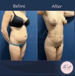 Vorher-nachher-Ergebnis Vaser-Liposuktion bei Db'est Clinic – sichtbare Körperkontur