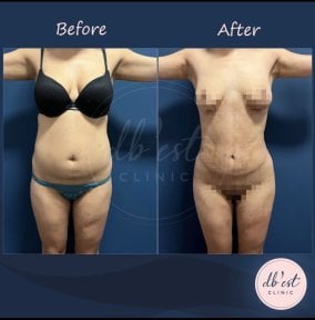 Before and after Vaser liposuction results at Db'est Clinic – visible body contour improvement