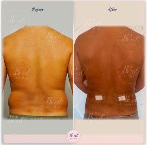 Vorher-nachher-Ergebnis der Vaser-Liposuktion am Rücken bei Db'est Clinic, sichtbare Kontur