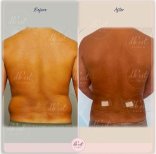 Vorher-nachher-Ergebnis der Vaser-Liposuktion am Rücken bei Db'est Clinic, sichtbare Kontur