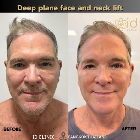 before-after photo mini-facelift