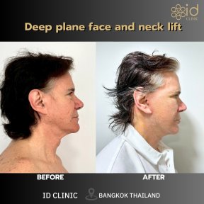 before-after photo mini-facelift