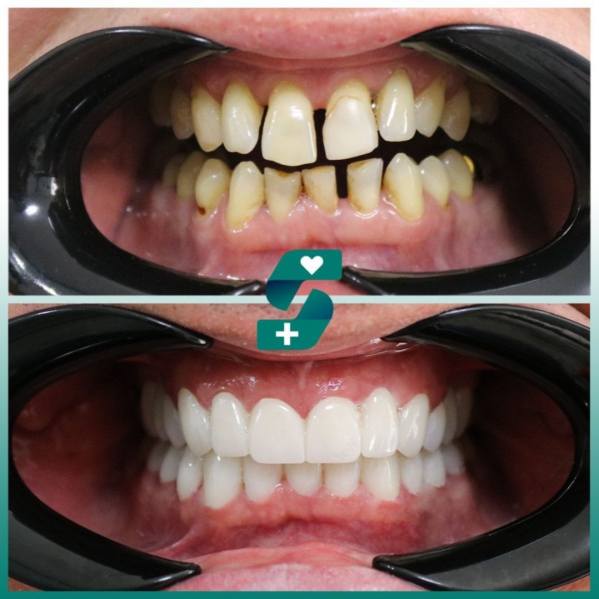 Antes y después de smile makeover en Soraca Med – resultado de carillas dentales, dientes blancos