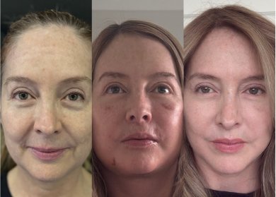 before-after photo lower-eyelid-surgery