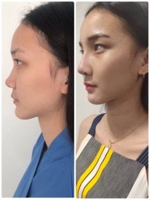 before-after photo rhinoplasty-nose-job