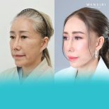 Результати до та після Ultherapy у Wansiri Hospital, безопераційна підтяжка обличчя