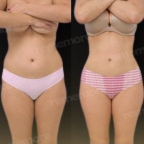 Before and after 360 liposuction results at Memorial Şişli Hospital, improved body contour