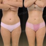Before and after 360 liposuction results at Memorial Şişli Hospital, improved body contour