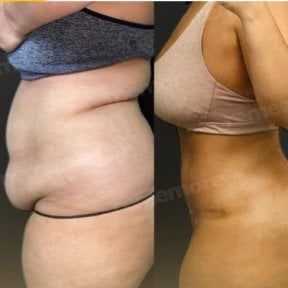 Before and after 360 liposuction results at Memorial Şişli Hospital, improved body contour