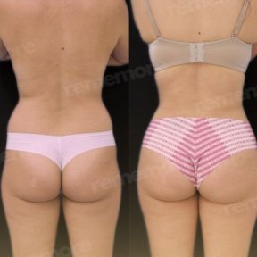 Before and after 360 liposuction results at Memorial Şişli Hospital, improved body contour