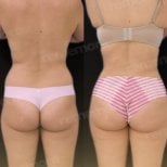 Before and after 360 liposuction results at Memorial Şişli Hospital, improved body contour
