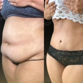 نتائج قبل وبعد شفط الدهون 360 في مستشفى ميموريال شيشلي، تحسين شكل البطن