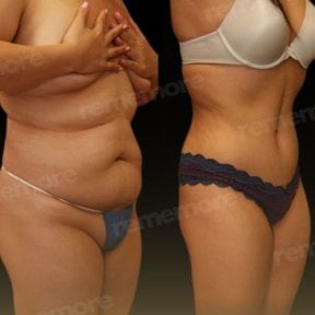 360 liposuction before and after results at Memorial Bahçelievler Hospital, body contouring