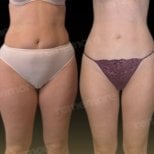 نتائج شفط الدهون 360 قبل وبعد في مستشفى ميموريال باهجيليفلر، تنسيق الجسم