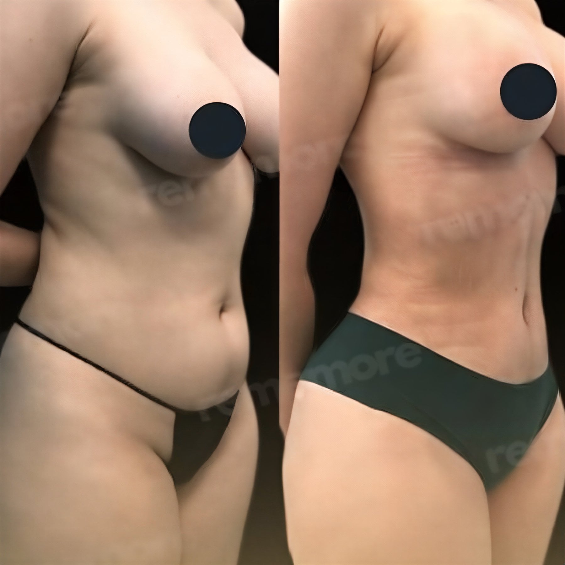 Resultados de liposucción 360 antes y después en Memorial Bahçelievler Hospital, contorno corporal
