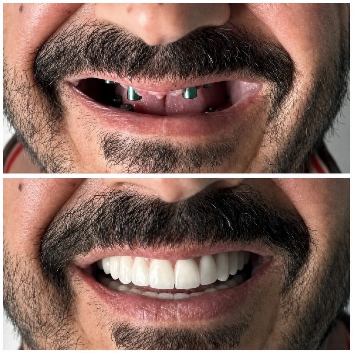 Resultado antes y después de implantes dentales All-on-6 en Santa Caterina Clinic, sonrisa restaurada