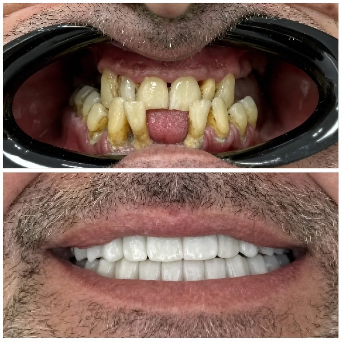 نتيجة قبل وبعد زراعة الأسنان All-on-6 في Santa Caterina Clinic، استعادة الابتسامة