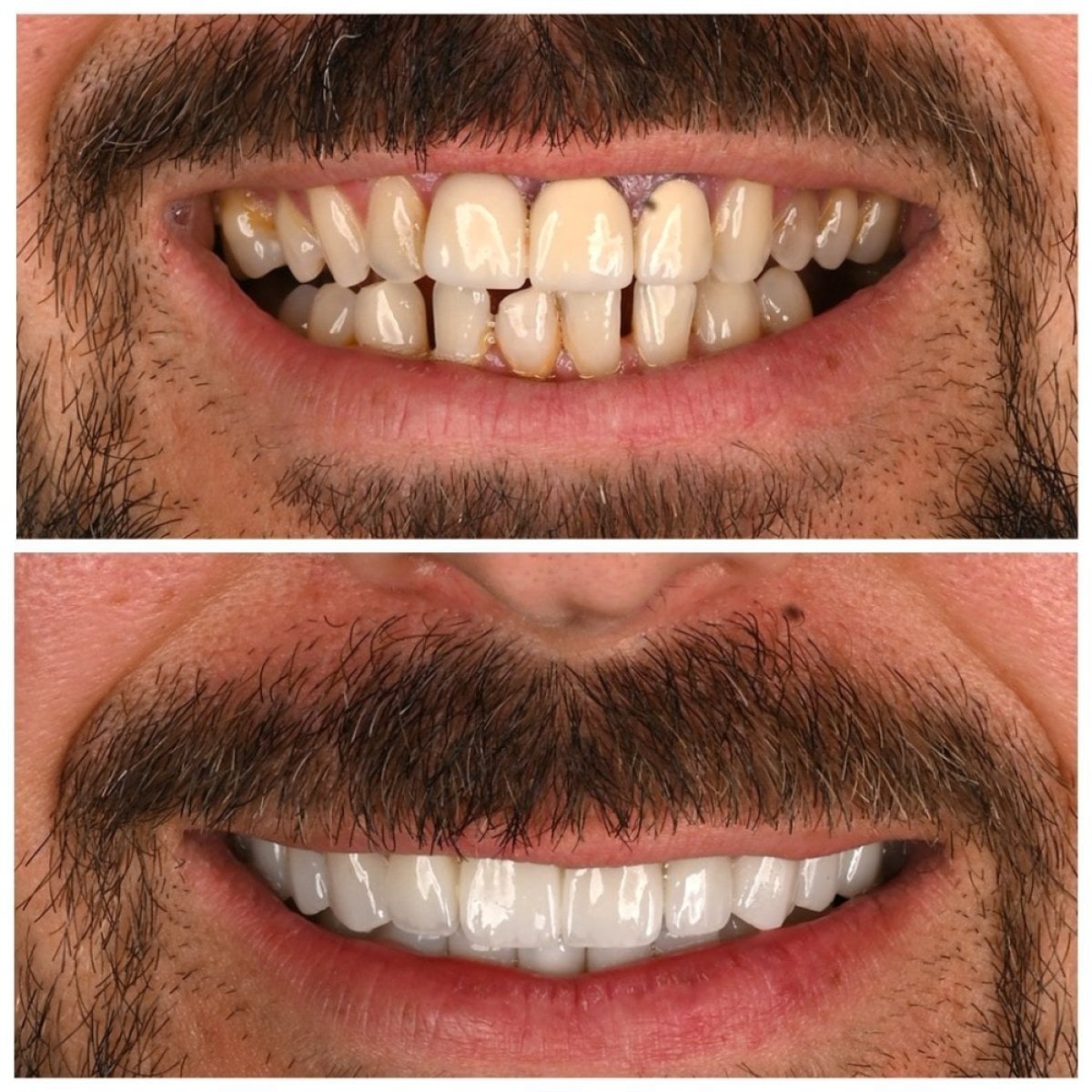 Antes y después de smile makeover en Soraca Med, alineación y blanqueamiento dental