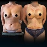 Before and after breast lift and tummy tuck results at Soraca Med, visible contour improvement