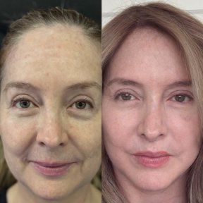 Vorher-nachher-Ergebnis der Unterlid-Blepharoplastik in der Marroquín & Sandoval Klinik