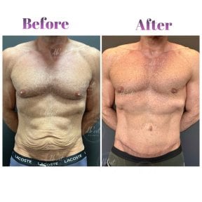 Before and after tummy tuck results at Db'est Clinic, improved abdominal contour in male patient