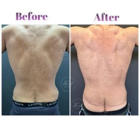 Before and after tummy tuck results at Db'est Clinic – improved lower back contour