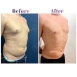 Before and after Vaser liposuction results at Db'est Clinic – improved male abdominal contour