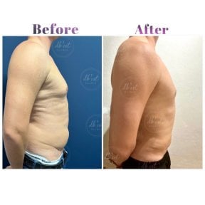 Vorher-nachher-Ergebnisse Vaser-Liposuktion bei Db'est Clinic – bessere Körperkontur Mann