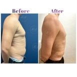 Vorher-nachher-Ergebnisse Vaser-Liposuktion bei Db'est Clinic – bessere Körperkontur Mann