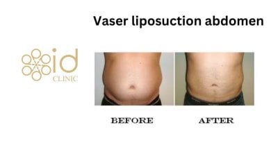 before-after photo vaser-liposuction