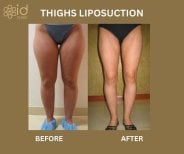Before and after thighs liposuction results at ID Clinic Bangkok, slimmer leg contour achieved