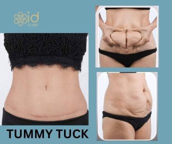 Before and after tummy tuck results at ID Clinic Bangkok, improved abdominal contour