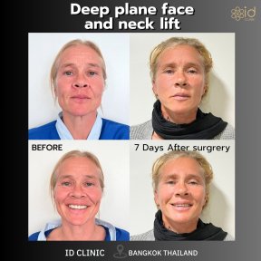 Before and after deep plane facelift and neck lift results at ID Clinic Bangkok, visible rejuvenation