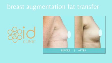 Before and after breast augmentation fat transfer results at ID Clinic Bangkok