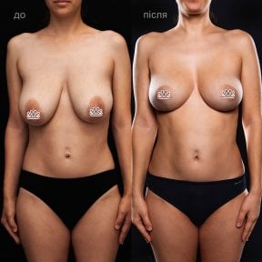 Résultats avant et après réduction mammaire à la Vidnova Clinic – forme améliorée des seins